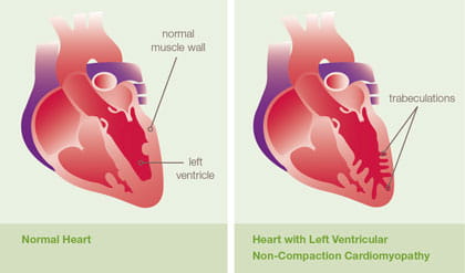 Left Ventricular Non-Compaction Cardiomyopathy (LVNC) illustration.